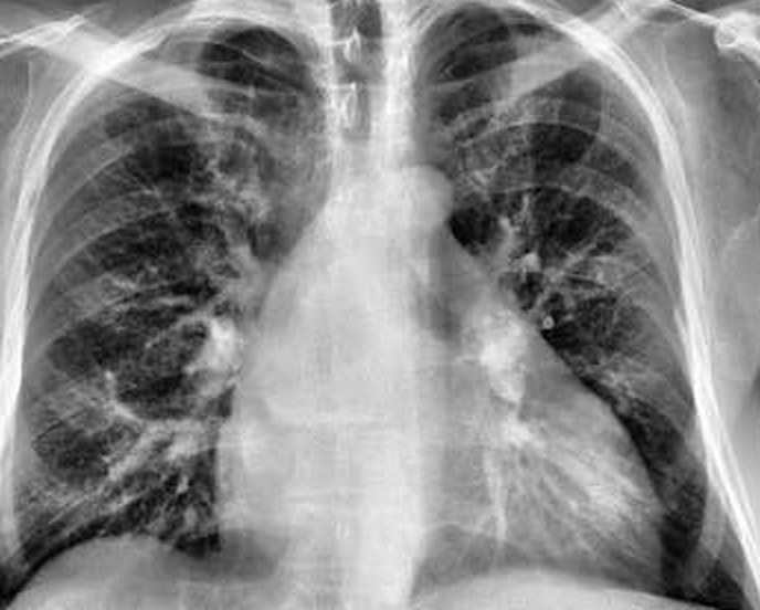 Chest X-ray, cropped to the chest cavity