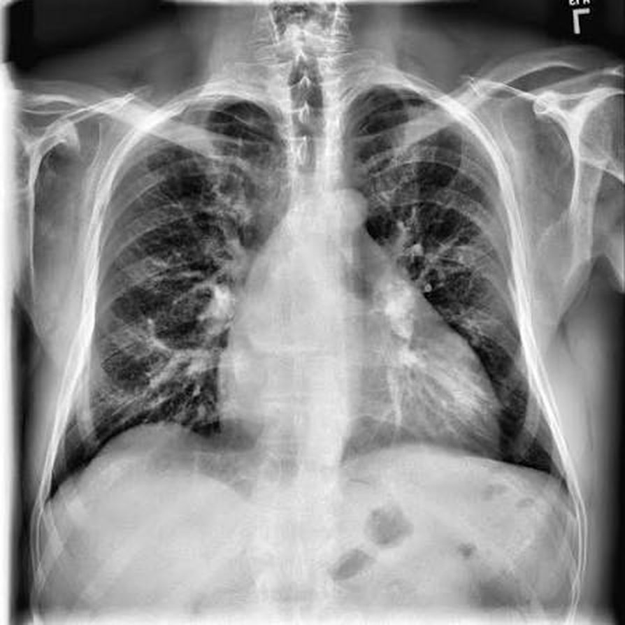 Full chest X-ray with the chest-cavity crop marked